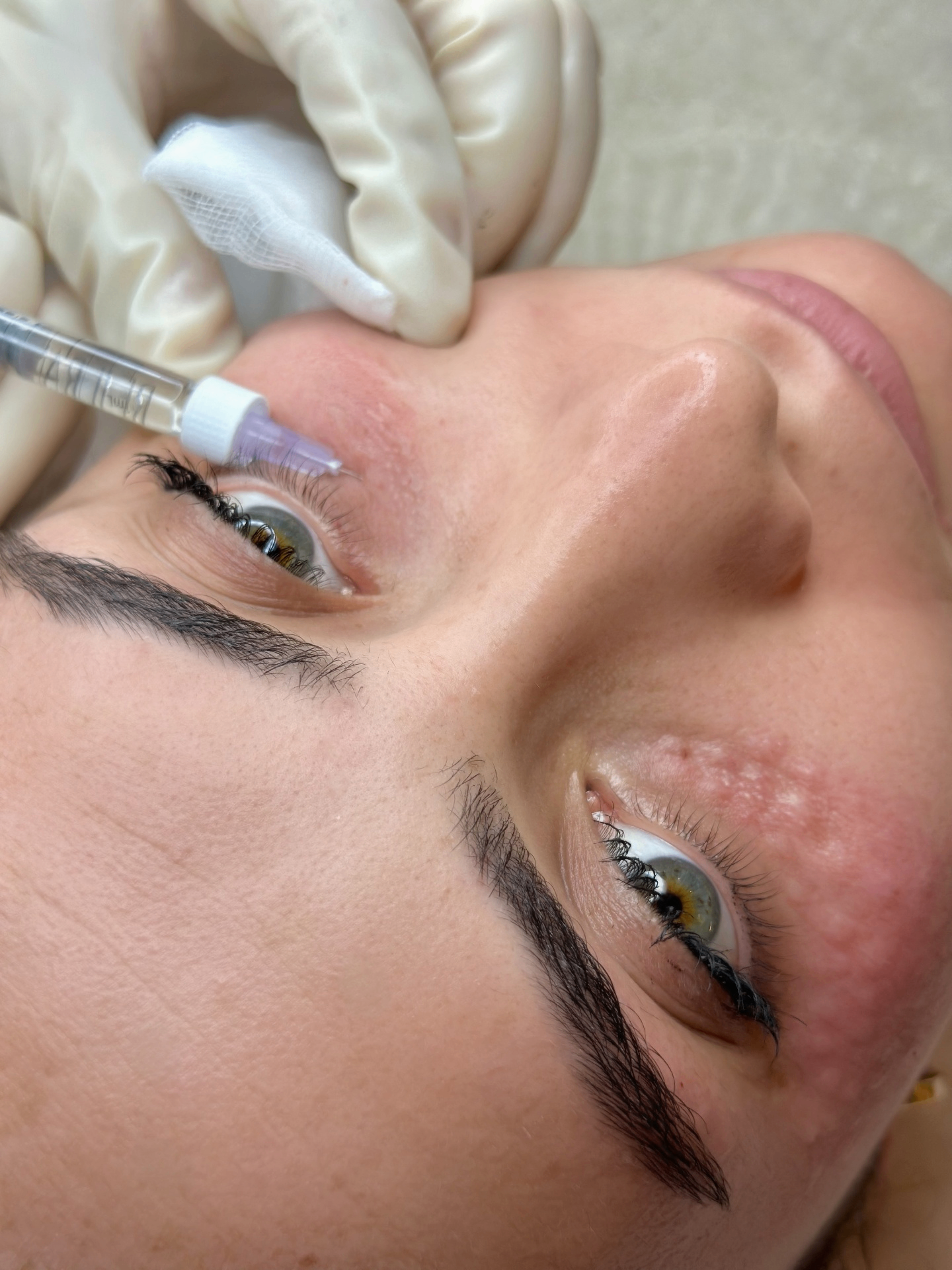 Rejuran treatment at TEUTÉ Advanced Aesthetics, Prishtina