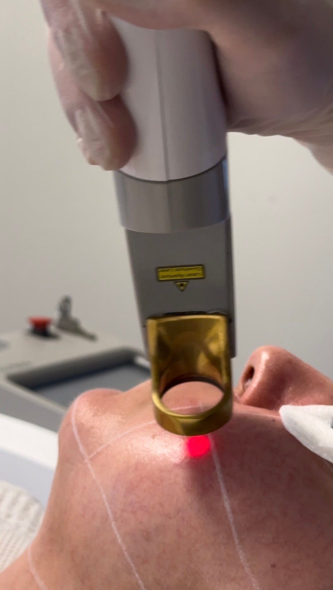 Genesis Laser treatment at TEUTÉ Advanced Aesthetics, Prishtina