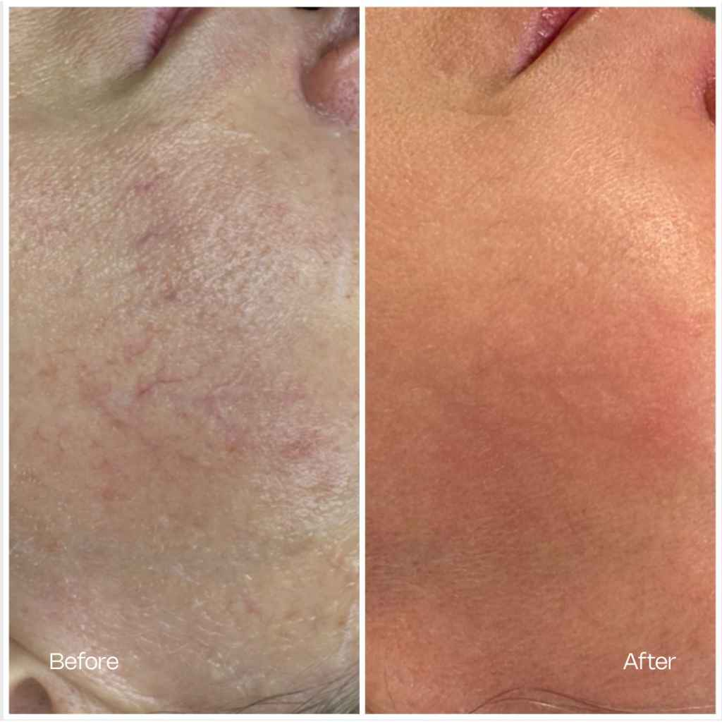 Before and after treatment result 2 — TEUTÉ Advanced Aesthetics, Prishtina