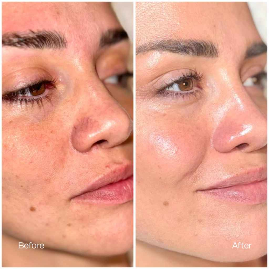 Before and after treatment result 1 — TEUTÉ Advanced Aesthetics, Prishtina