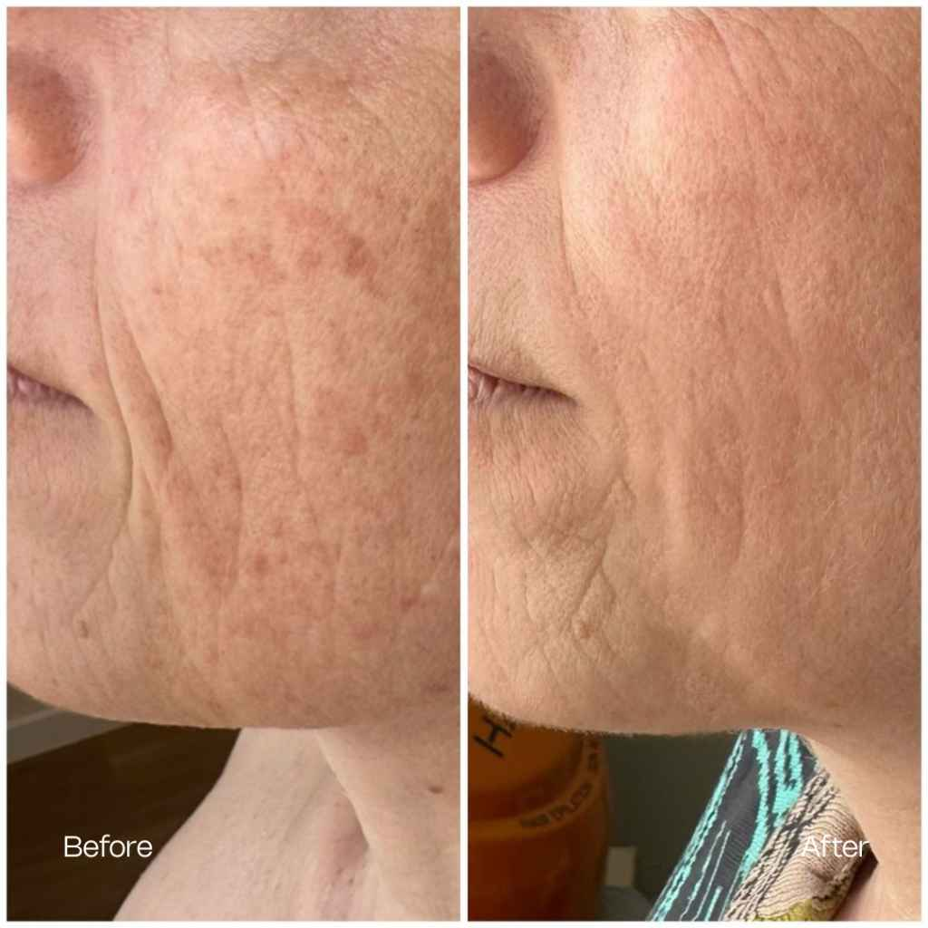 Before and after treatment result 3 — TEUTÉ Advanced Aesthetics, Prishtina
