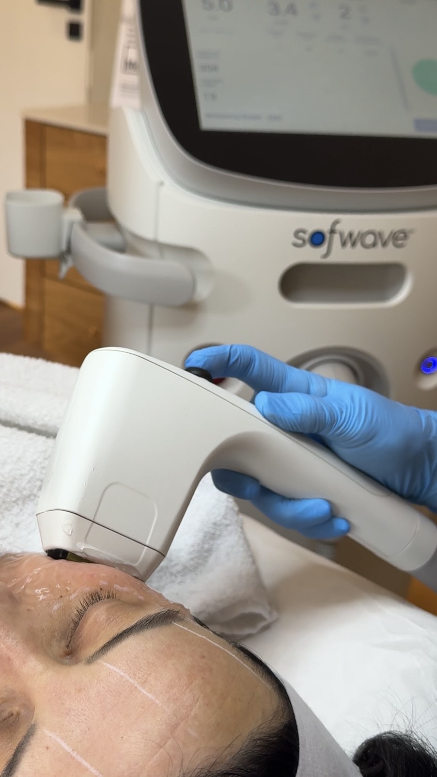 Sofwave treatment at TEUTÉ Advanced Aesthetics, Prishtina