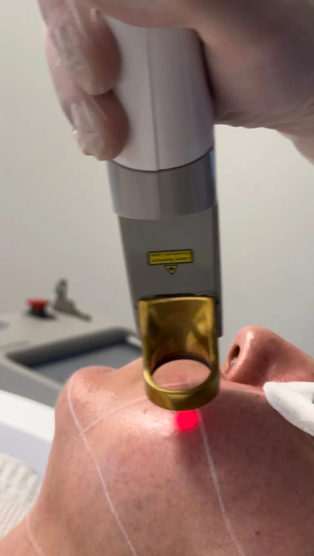 Genesis Laser treatment at TEUTÉ Advanced Aesthetics, Prishtina